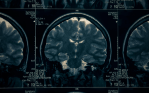 wet brain alcohol addiction